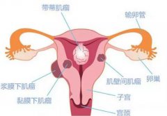 安琪儿妇科专家教你：子宫肌瘤的防与治